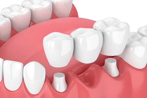 Dental Bridges