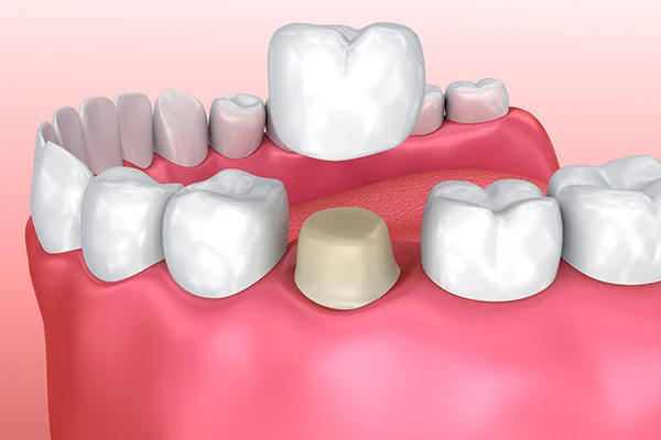 Dental Crown