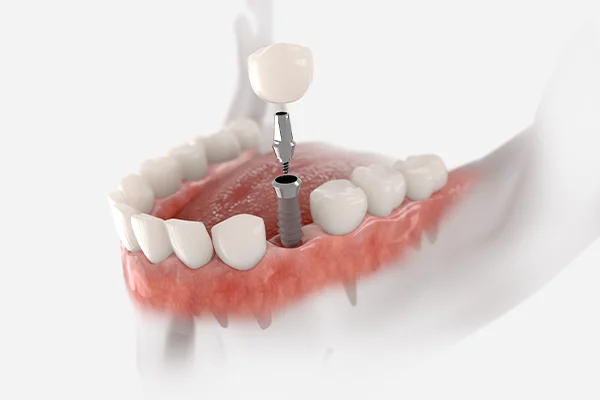 Dental Implants