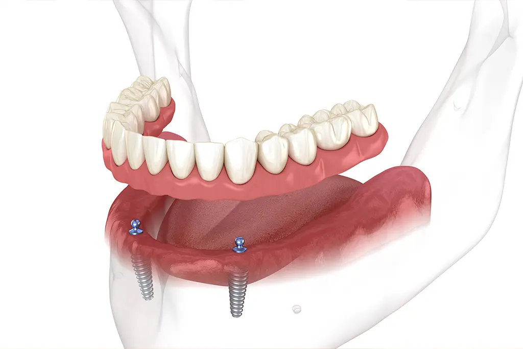 How Denture Stabilization Improves Chewing