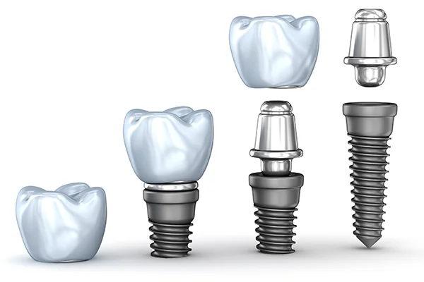 dental implants
