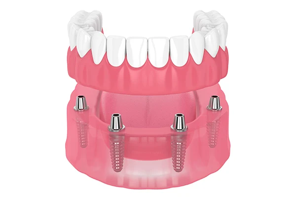 Denture Stabilization