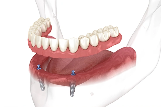 Denture Implants