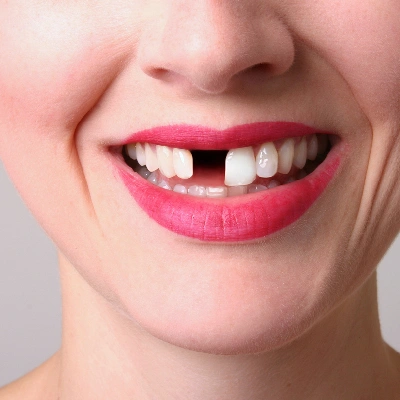 Why Does Losing One Tooth Matter