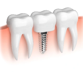 Single Tooth Replacement Options