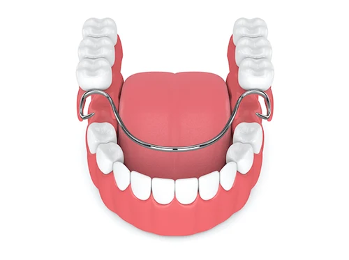 Partial Dentures