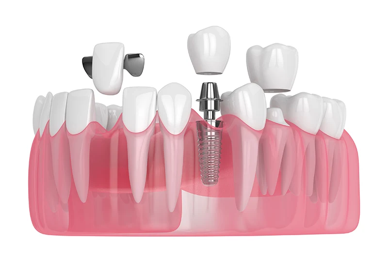 Types of Dental Crowns