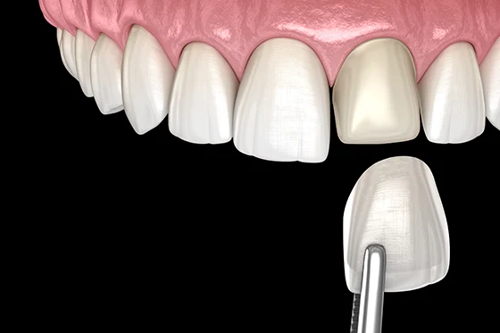 Dental Veneers