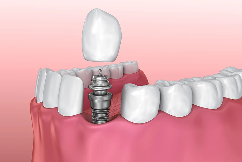 Are Single Dental Implants Worth It