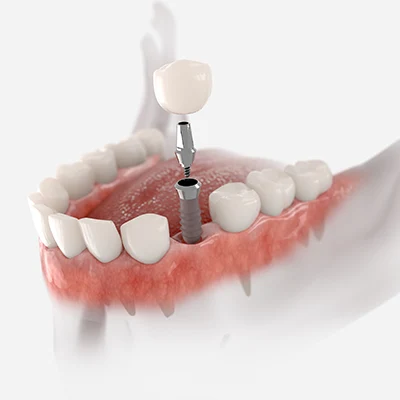 What is a Single Dental Implant