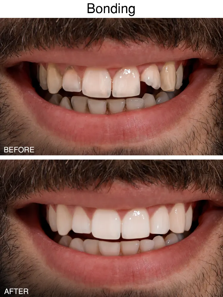Dental Bonding Before After in Sterling Height, MI