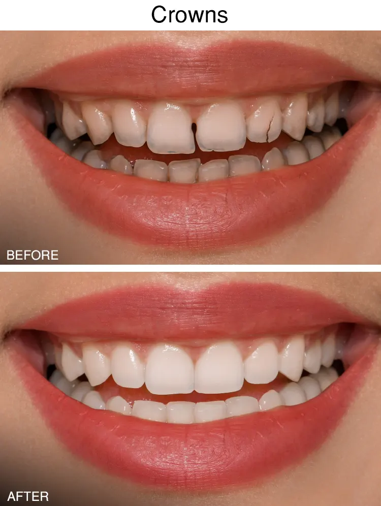 Dental Crowns Before After in Sterling Height, MI