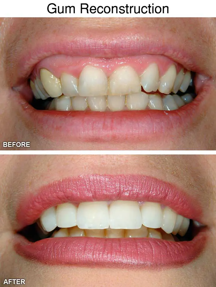 Gum Reconstruction Before After in Sterling Height, MI