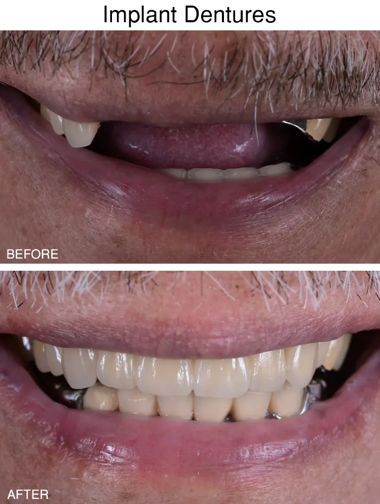 Implant Denture Before After in Sterling Height, MI