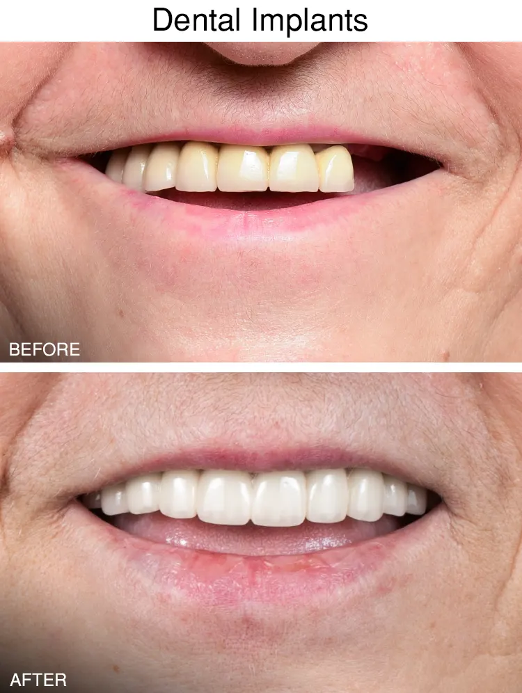 Dental Implants Before After in Sterling Height, MI