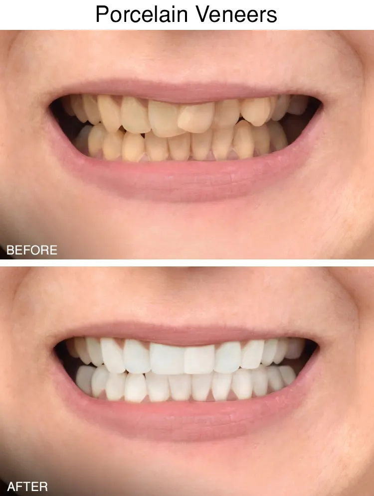 Dental Veneers Before After in Sterling Height, MI