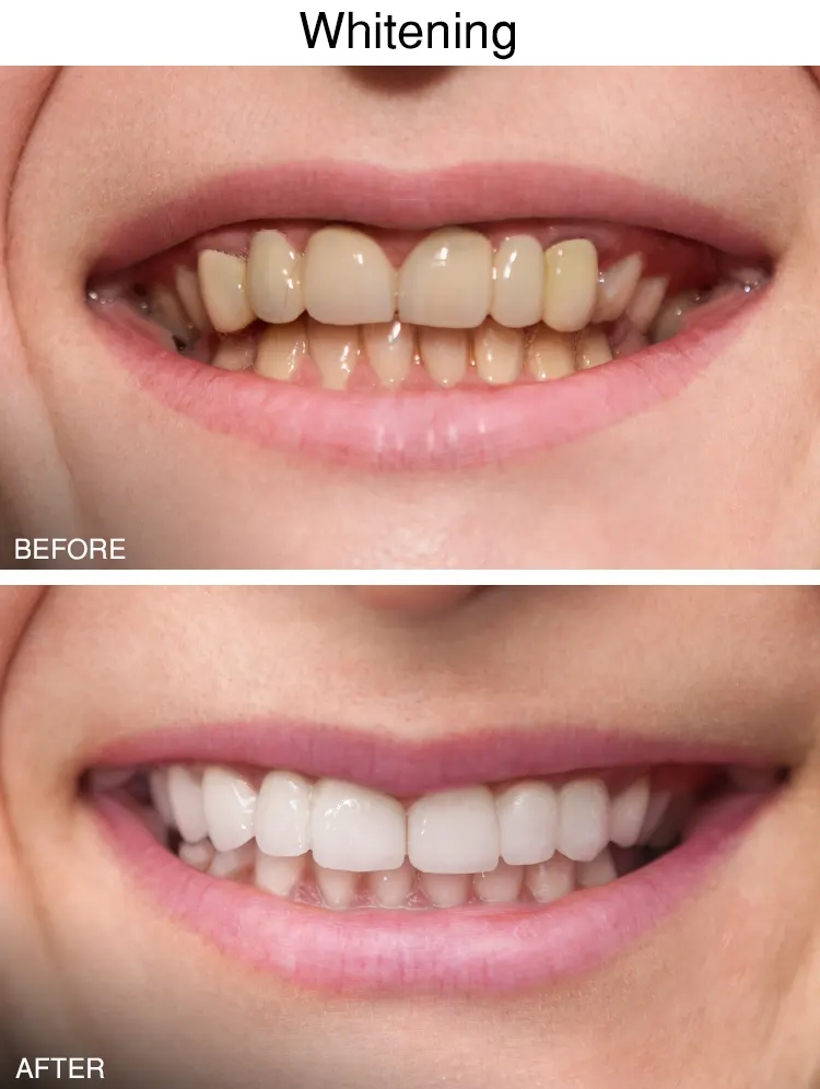 Teeth Whitening Before After in Sterling Height, MI