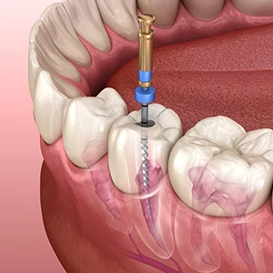 Root Canal in Sterling Heights, MI